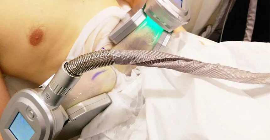 cryolipolysis-faq